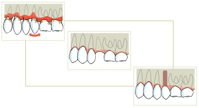 ¿A un paciente que padezca enfermedad periodontal le pueden ser colocados implantes dentales?