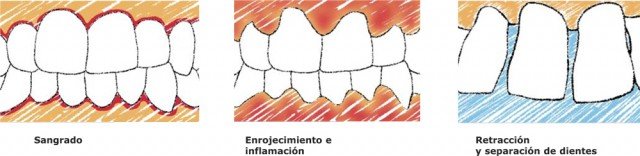 ¿Cómo saber si mi encía está enferma?