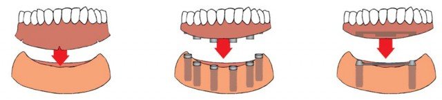 ¿Cómo puedo rehabilitar la boca cuando me faltan todos los dientes y muelas?