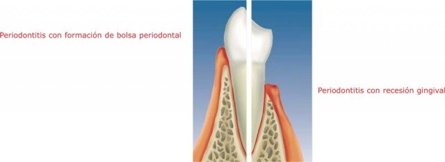 ¿Cuales son las enfermedades del periodonto?