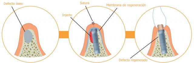 ¿Cuándo puedo necesitar procedimientos quirúrgicos especiales?
