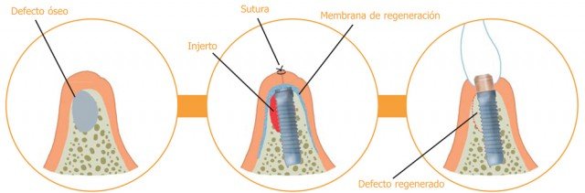 ¿Cuándo puedo necesitar procedimientos quirúrgicos especiales?