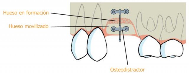 ¿Cuándo puedo necesitar procedimientos quirúrgicos especiales?