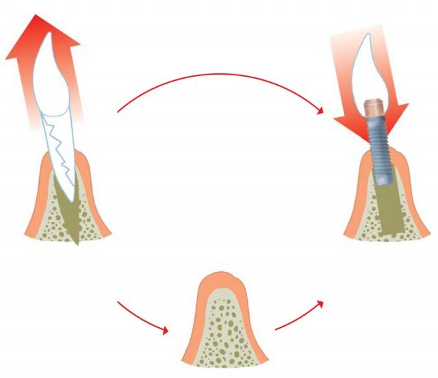 ¿Puedo colocarme los implantes en el momento de quitarme los dientes o debo esperar?