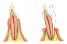 ¿Es reversible la movilidad dental producida por periodontitis?