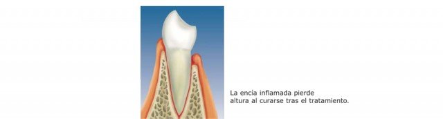 ¿Mejora el tratamiento periodontal la estética bucal?