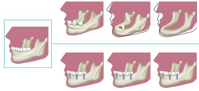 ¿Para qué sirven los implantes dentales?