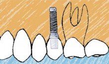 ¿Puedo colocarme implantes si tengo enfermedad periodontal?