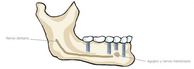 ¿Qué complicaciones pueden presentarse durante el tratamiento con implantes dentales?