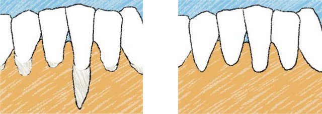 ¿Qué es la cirugía estética periodontal?