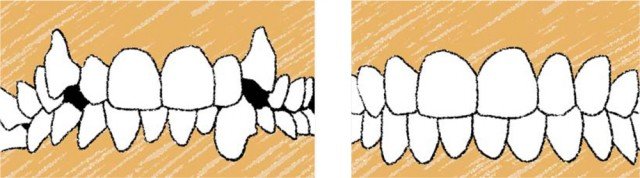 ¿Qué relación guardan las malposiciones dentarias con la enfermedad periodontal?