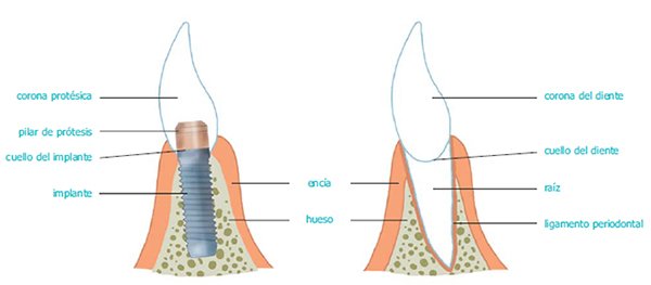 ¿Qué son los implantes dentales?