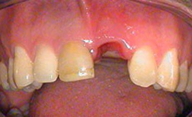 Before-Implantes