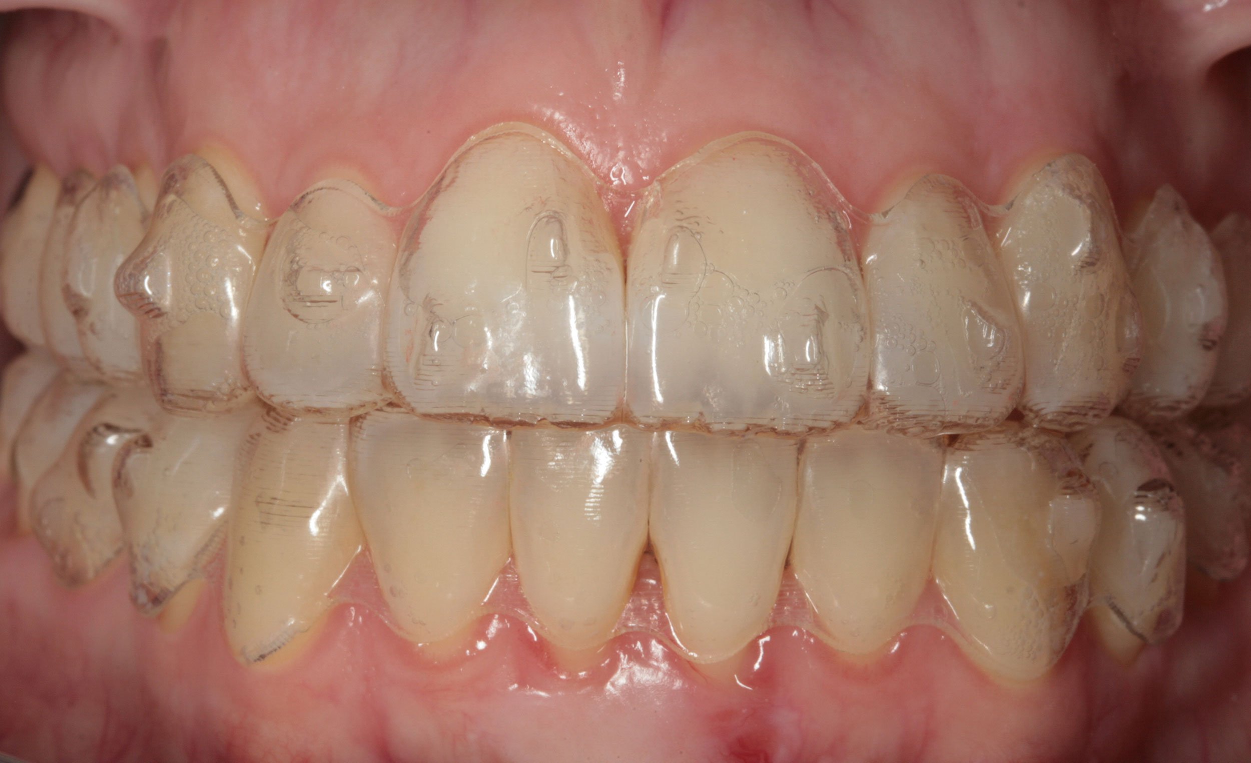 Before-Ortodoncia invisible (Invisalign)