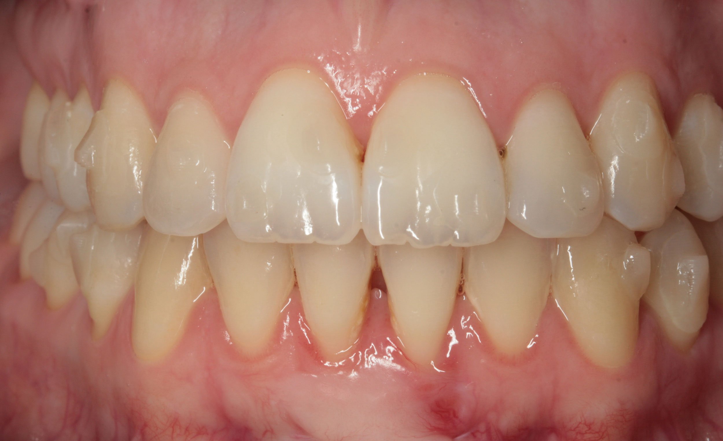 After-Ortodoncia invisible (Invisalign)