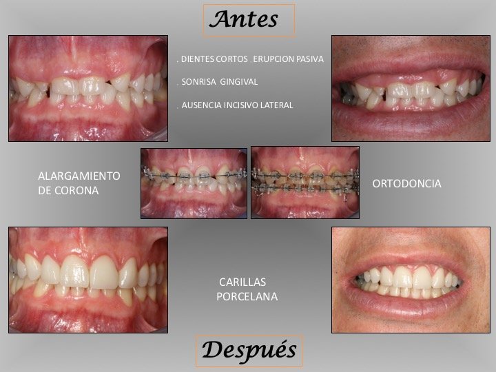 sonrisa gingival