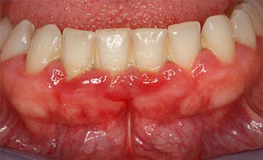 Before-Tratamiento periodontal avanzado