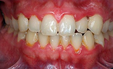 Before-Tratamiento periodontal básico