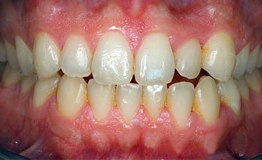 After-Tratamiento periodontal básico